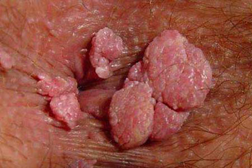 Hình ảnh của bệnh sùi mào gà ở hậu môn