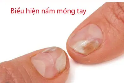 Biểu hiện nấm móng tay