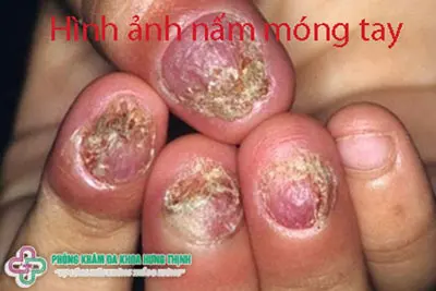 Nấm móng tay là gì? 