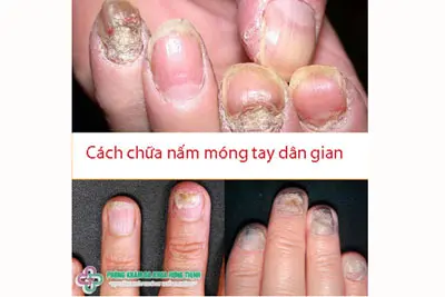 Cách chữa nấm móng tay hiệu quả tại nhà
