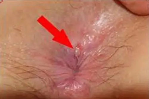 Hình ảnh bệnh nứt kẽ hậu môn thường gặp nhất