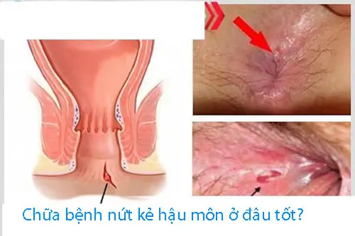 Chữa bệnh nứt kẽ hậu môn ở đâu tốt?