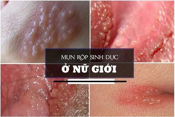 Hình ảnh nổi mụn ở vùng kín nữ