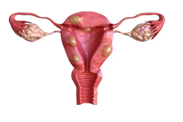 Hình ảnh bệnh u xơ tử cung