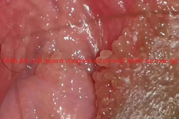 Hình ảnh nổi mụn ở vùng kín nữ do mắc bệnh sùi mào gà