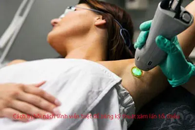 Cách trị hôi nách vĩnh viễn triệt để bằng kỹ thuật xâm lấn tối thiểu