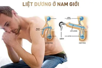 Liệt dương là gì?
