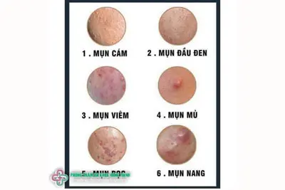 Biểu hiện của mụn trứng cá tuổi dậy thì