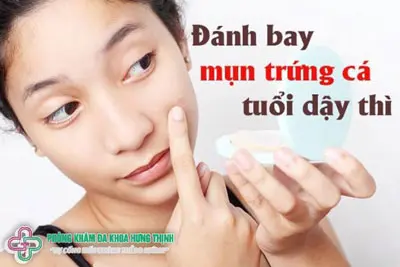 Điều trị mụn trứng cá dậy thì tại phòng khám da liễu
