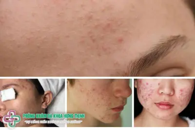 Các vị trí mụn trứng cá xuất hiện trên mặt