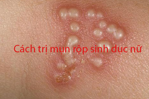 Cách trị mụn rộp sinh dục nữ