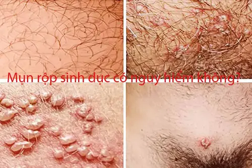 Mụn rộp sinh dục nam có nguy hiểm không?
