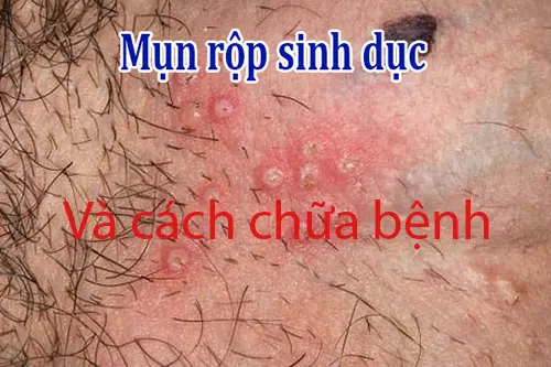 Cách chữa mụn rộp sinh dục