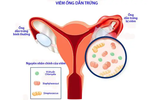 Do tổn thương ống dẫn trứng