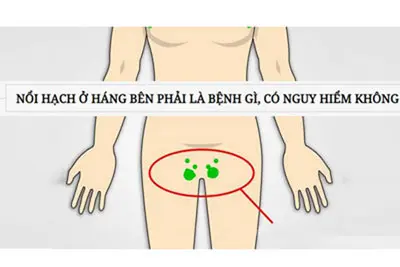Nổi hạch ở háng có nguy hiểm không?