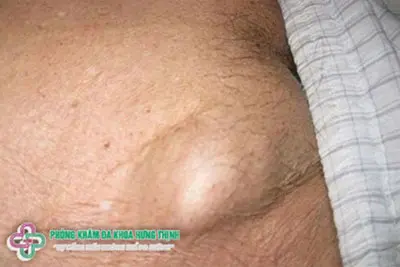 Nổi hạch ở háng do mắc bệnh xã hội