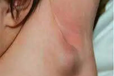 Nguyên nhân ác tính gây nổi hạch ở nách phải, trái
