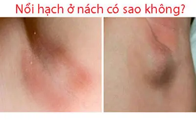 Nổi hạch ở nách có sao không?