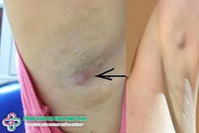 Nguyên nhân nổi hạch ở nách