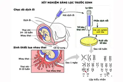 Xét nghiệm NIPT sàng lọc trước sinh