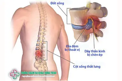 Thoát vị đĩa đệm thắt lưng là gì?