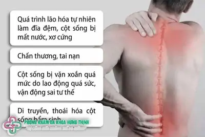 Nguyên nhân thoát vị đĩa đệm thắt lưng