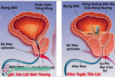 Dấu hiệu triệu chứng viêm tuyến tiền liệt