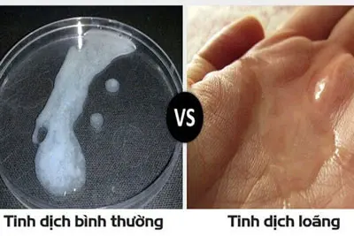 Tinh trùng loãng như nước có sao không