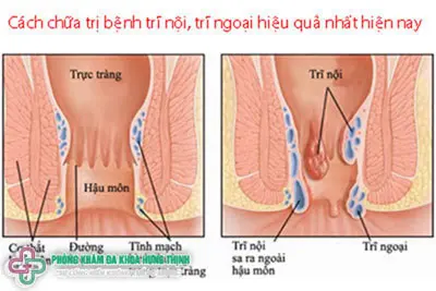 Cách chữa bệnh trĩ hiệu quả