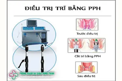 Điều trị bệnh trĩ bằng kỹ thuật PPH và HCPT