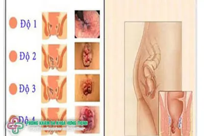 Bệnh trĩ là gì?