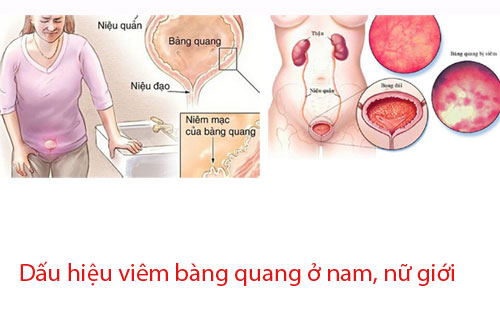 Dấu hiệu viêm bàng quang ở nam, nữ giới