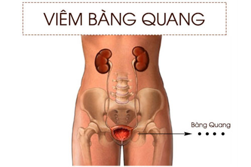 Bệnh viêm bàng quang là gì?