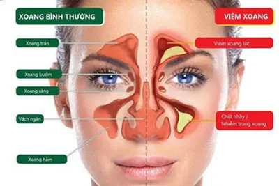 Viêm xoang là gì? Nguyên nhân gây bệnh viêm xoang