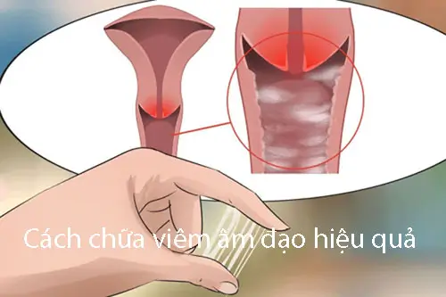 Cách chữa viêm âm đạo hiệu quả