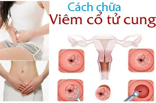 Cách chữa viêm cổ tử cung tốt nhất