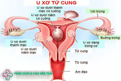 Ung thư cổ tử cung