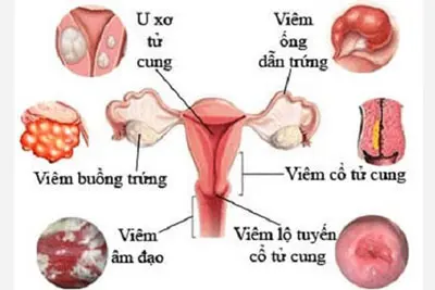 Phòng tránh các bệnh phụ khoa nguy hiểm