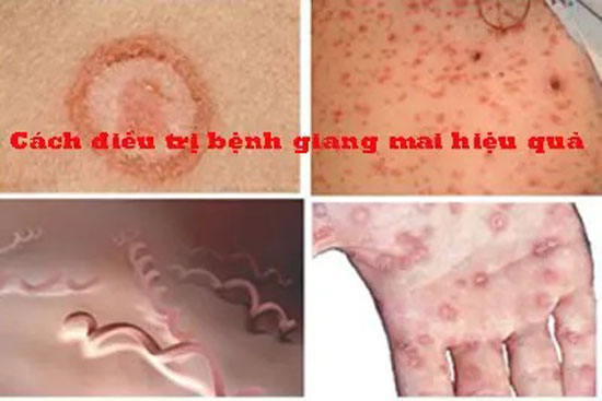 12 Cách chữa trị bệnh giang mai hiệu quả tại nhà
