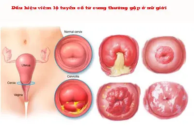 Dấu hiệu của bệnh viêm lộ tuyến cổ tử cung thường gặp