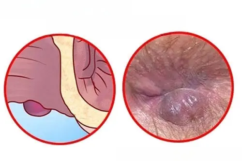 Hình ảnh bị trĩ ngoại giai đoạn 1