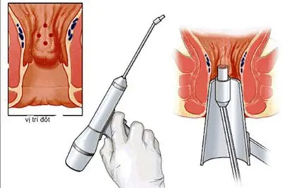 Cách điều trị trĩ nội bằng thủ thuật chích xơ búi trĩ