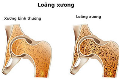  Loãng xương