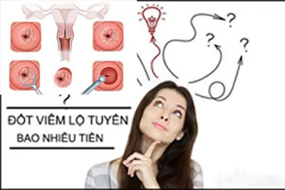 Chi phí đốt viêm lộ tuyến cổ tử cung hết bao nhiêu tiền?cung bao nhiêu tiền?