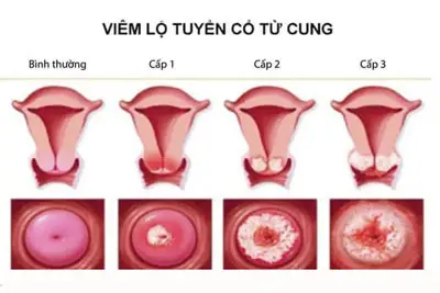 Hình ảnh viêm lộ tuyến cổ tử cung cấp độ 1, 2, 3, 4 từng giai đoạn