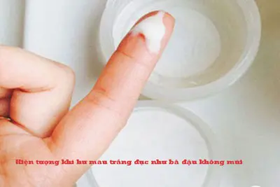 Hiện tượng khí hư màu trắng đục như bã đậu 