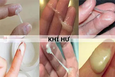 Khí hư màu trắng đục không mùi là bị bệnh gì?