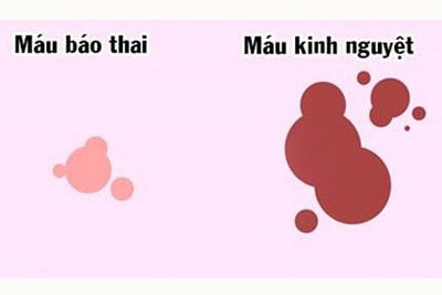 Máu báo thai khác máu kinh nguyệt như thế nào?