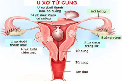 U xơ tử cung có ảnh hưởng đến khí hư màu nâu