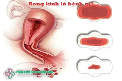 Rong kinh là bệnh gì?